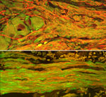 A surviving cluster of transplanted neurons at the graft extremity (top) with axons in the center (bottom).  In both images, transplanted nerve cells are labeled green and axons are stained red.  These axons are a mix of the transplanted axons and host axons, which intertwined as regeneration occurred directly across the transplanted tissue.